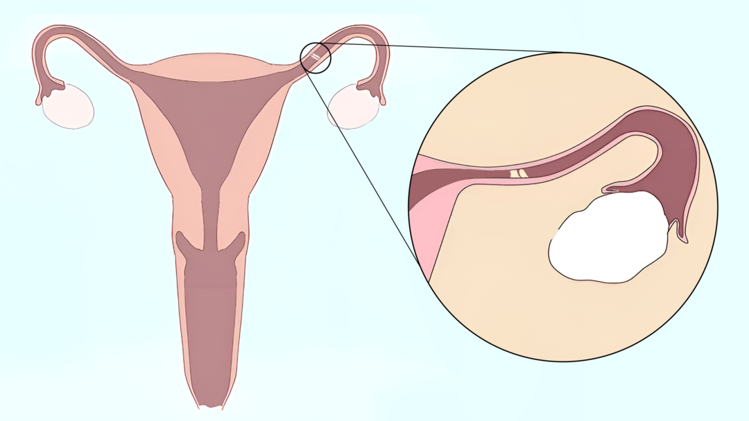 Blocked Fallopian Tube